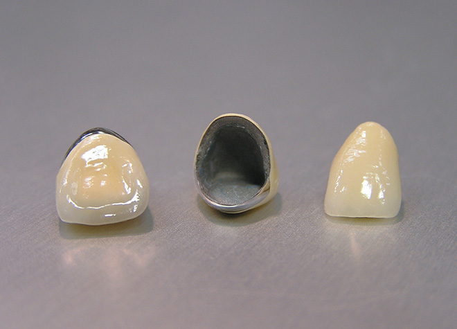 のざき歯科医院のメタルボンド