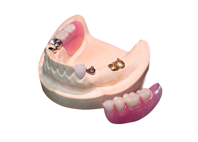 のざき歯科医院のアタッチメント義歯