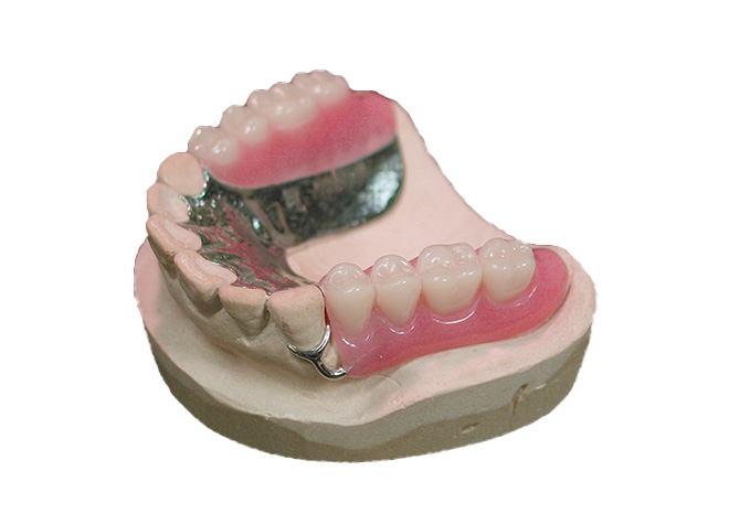 のざき歯科医院の金属床