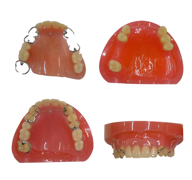 のざき歯科医院のクラスプ義歯（従来）