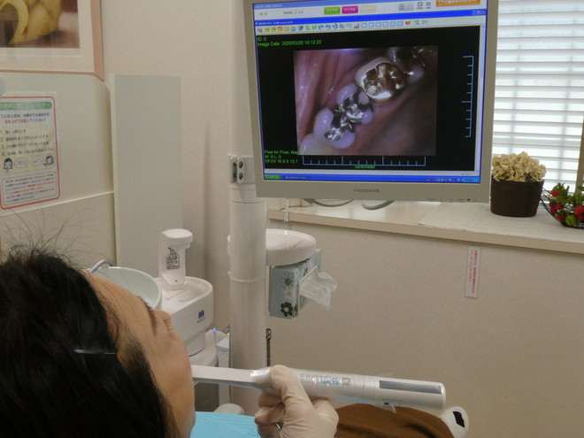 のざき歯科医院の口腔内カメラ１